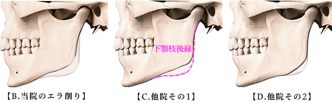 当院のエラ削り