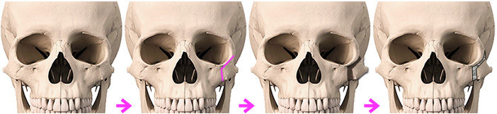 頬骨弓拡大術