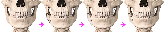 下顎枝外板移動術