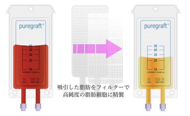 ピュアグラフトについて