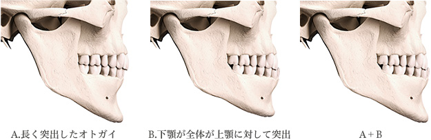 突出したアゴを引っ込める施術