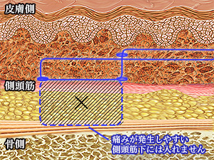 糸の固定方法に工夫した施術を行っています