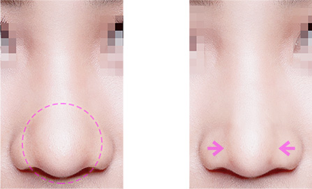 鼻尖縮小について