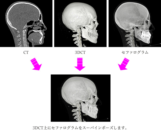 3DCT上にセファログラムをスーパインポーズします