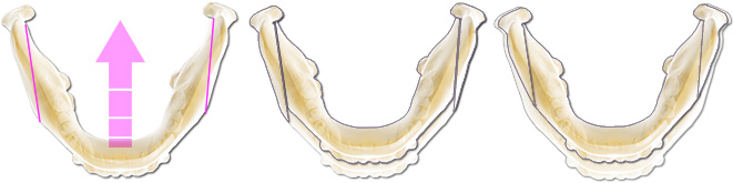 下顎枝矢状分割術(Sagital Split Ramus Osteotomy: SSRO)