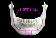 骨切りします